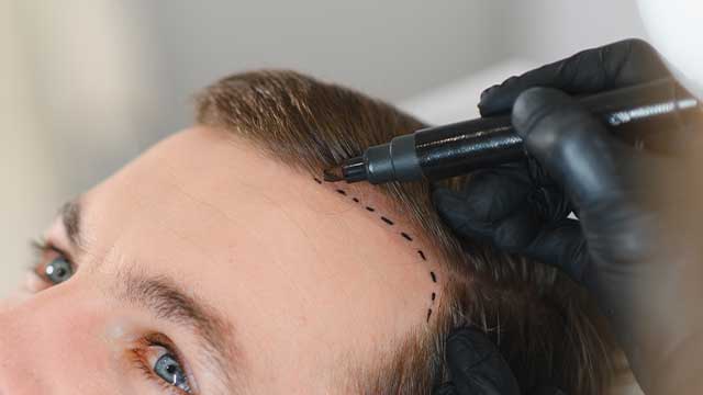 Σχεδιασμός hairline σε μεταμόσχευση μαλλιών FUE